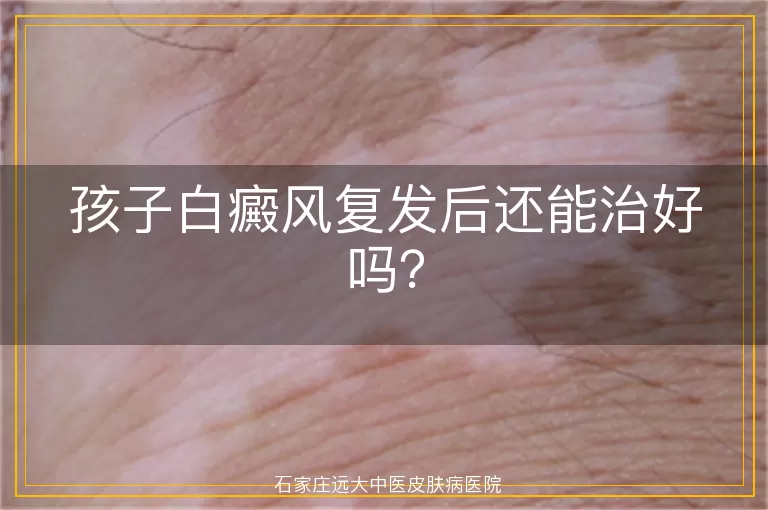 孩子白癜风复发后还能治好吗？