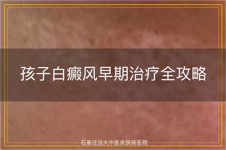 孩子白癜风早期治疗全攻略