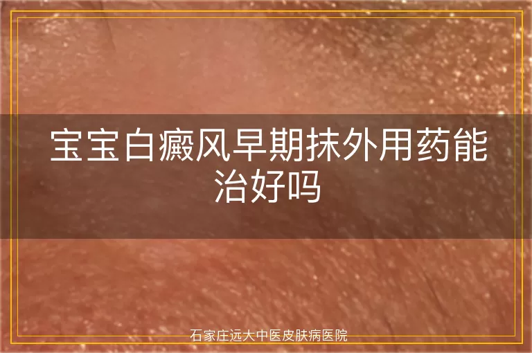 宝宝白癜风早期抹外用药能治好吗