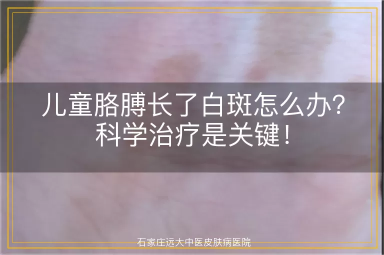 儿童胳膊长了白斑怎么办？科学治疗是关键！