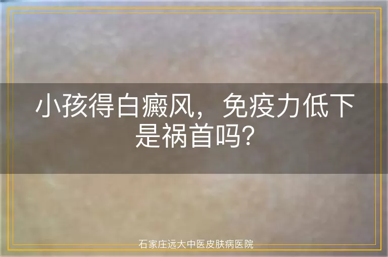 小孩得白癜风，免疫力低下是祸首吗？