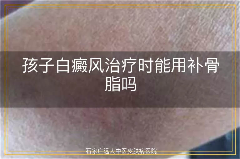 孩子白癜风治疗时能用补骨脂吗
