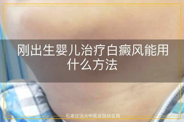 刚出生婴儿治疗白癜风能用什么方法