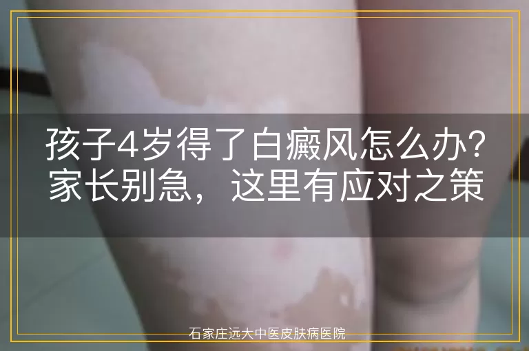 孩子4岁得了白癜风怎么办？家长别急，这里有应对之策