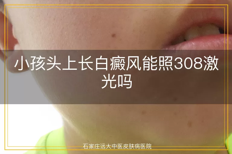 小孩头上长白癜风能照308激光吗