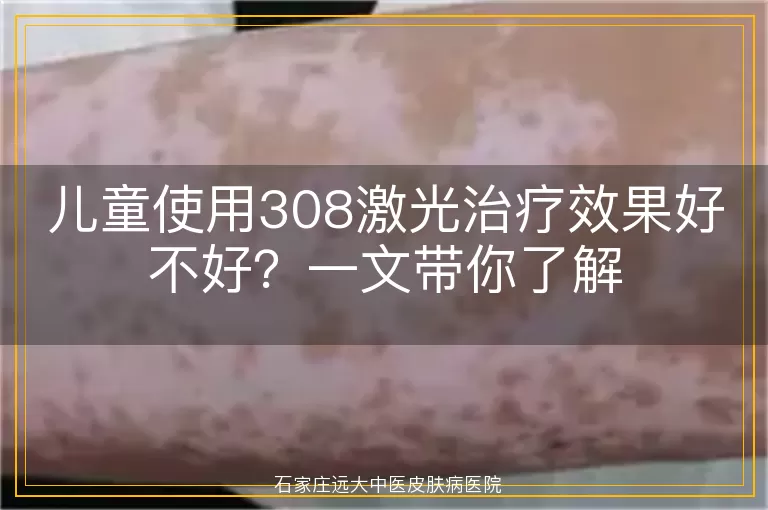 儿童使用308激光治疗效果好不好？一文带你了解