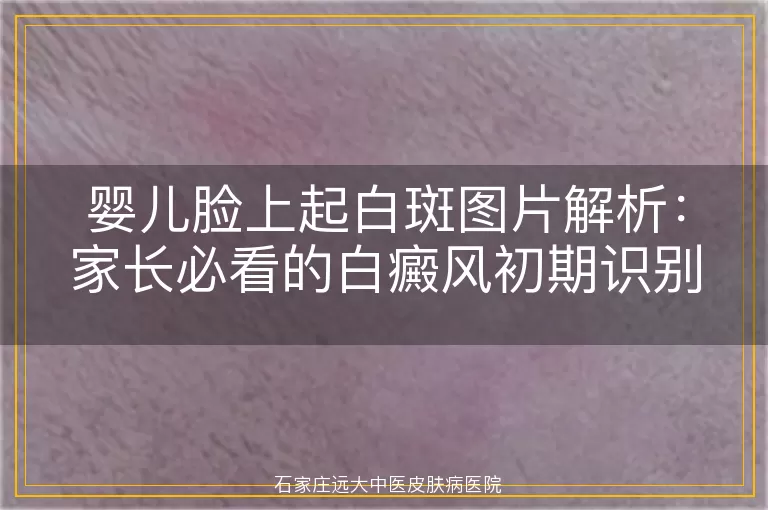 婴儿脸上起白斑图片解析：家长必看的白癜风初期识别指南