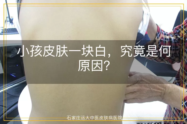 小孩皮肤一块白，究竟是何原因？