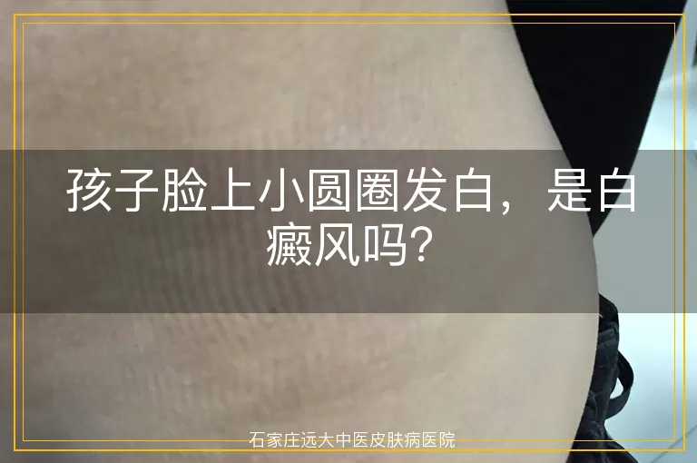 孩子脸上小圆圈发白，是白癜风吗？