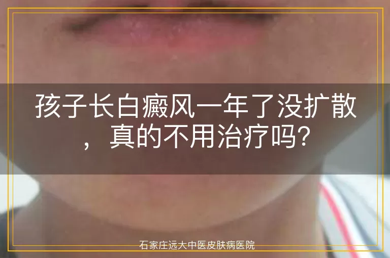 孩子长白癜风一年了没扩散，真的不用治疗吗？