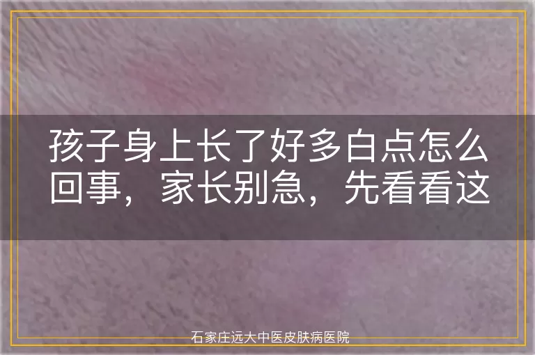 孩子身上长了好多白点怎么回事，家长别急，先看看这些可能的原因
