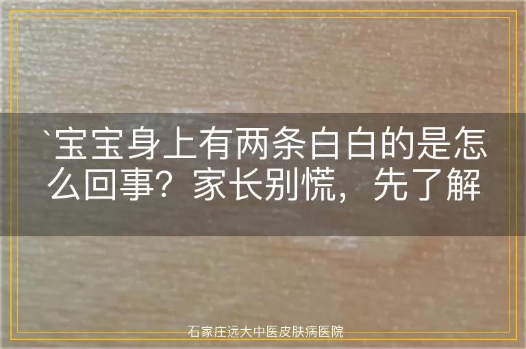 宝宝身上有两条白白的是怎么回事？家长别慌，先了解这些！