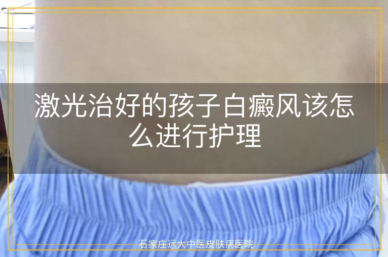 激光治好的孩子白癜风该怎么进行护理