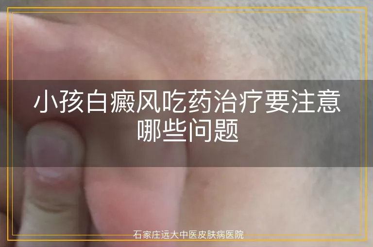 小孩白癜风吃药治疗要注意哪些问题