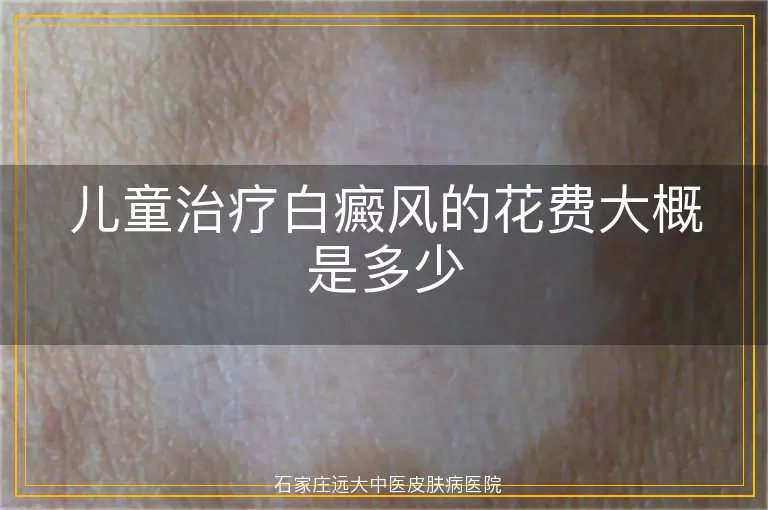 儿童治疗白癜风的花费大概是多少