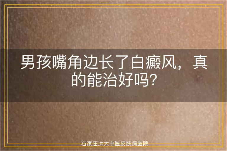 男孩嘴角边长了白癜风，真的能治好吗？
