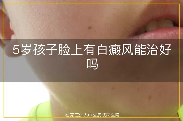 5岁孩子脸上有白癜风能治好吗
