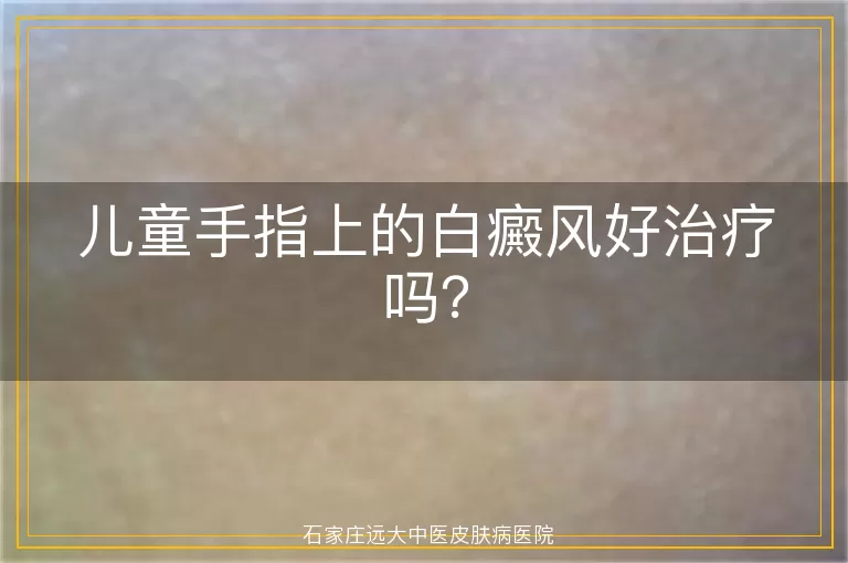 儿童手指上的白癜风好治疗吗？