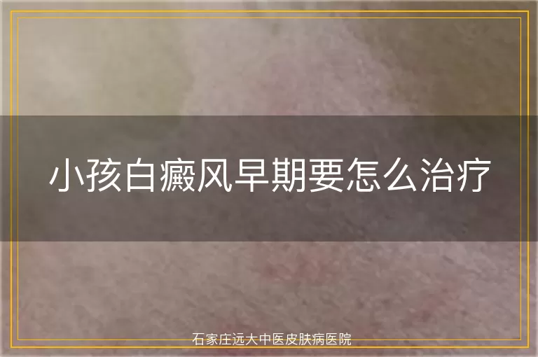 小孩白癜风早期要怎么治疗