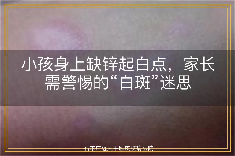 小孩身上缺锌起白点，家长需警惕的“白斑”迷思