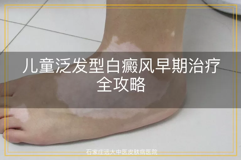 儿童泛发型白癜风早期治疗全攻略