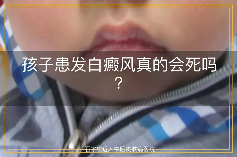 孩子患发白癜风真的会死吗？