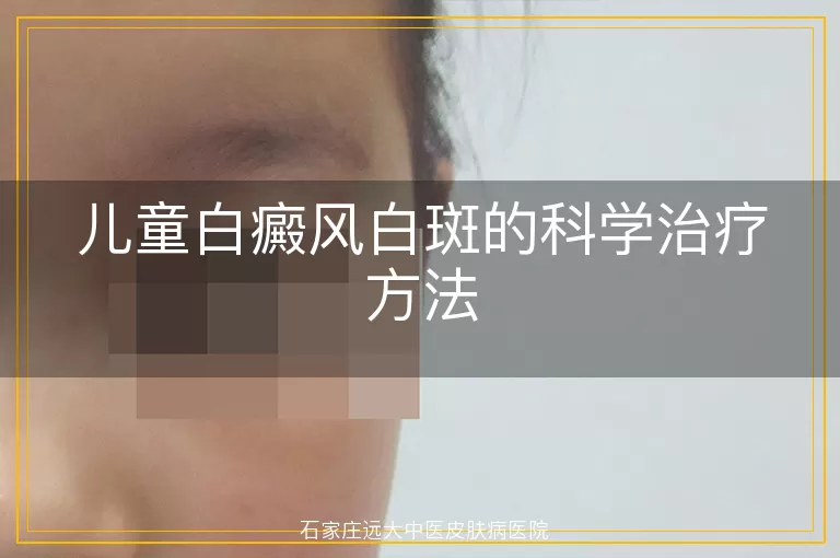 儿童白癜风白斑的科学治疗方法