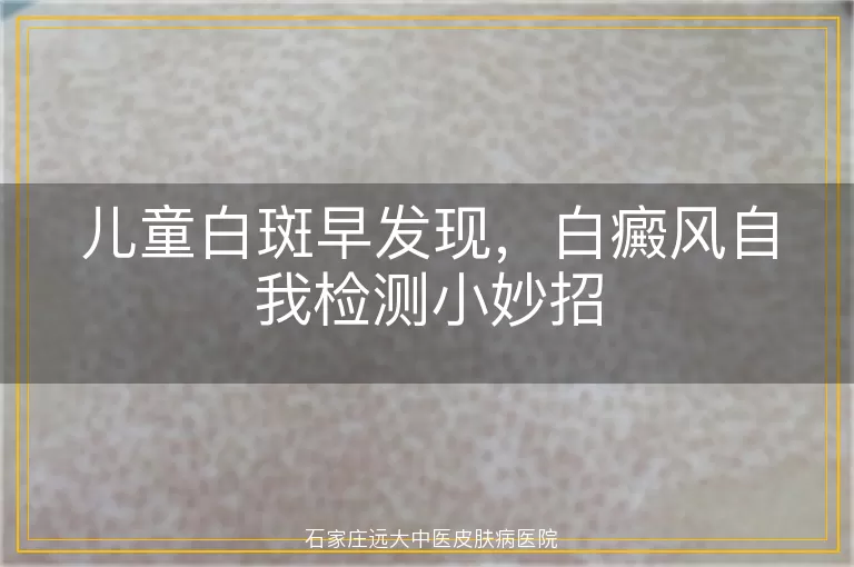 儿童白斑早发现，白癜风自我检测小妙招