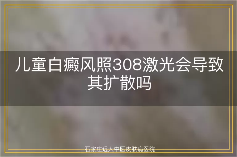 儿童白癜风照308激光会导致其扩散吗