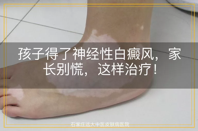 孩子得了神经性白癜风，家长别慌，这样治疗！