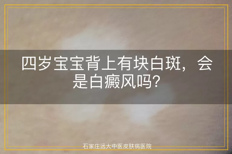 四岁宝宝背上有块白斑，会是白癜风吗？