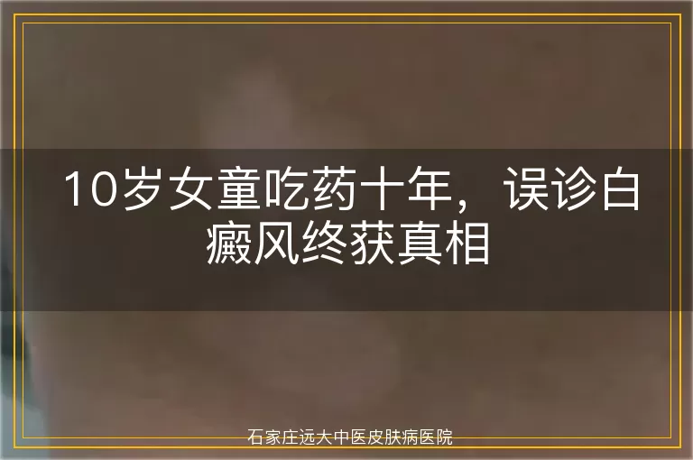 10岁女童吃药十年，误诊白癜风终获真相