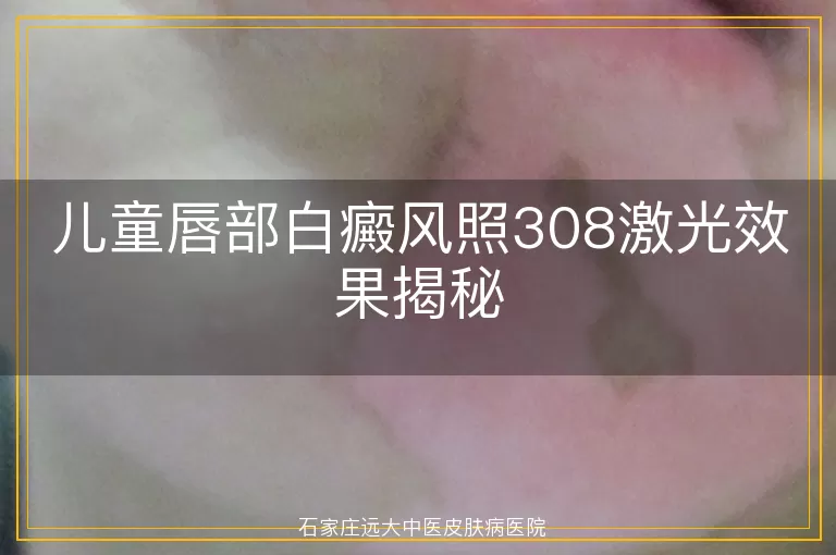 儿童唇部白癜风照308激光效果揭秘