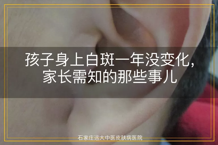 孩子身上白斑一年没变化，家长需知的那些事儿