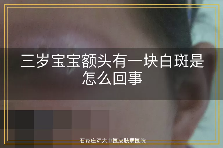 三岁宝宝额头有一块白斑是怎么回事