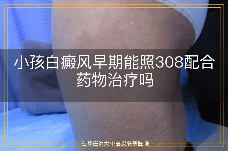 小孩白癜风早期能照308配合药物治疗吗