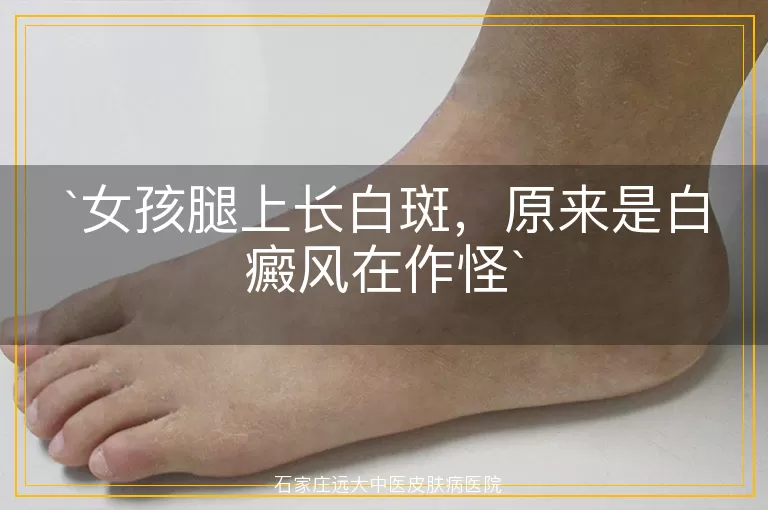 女孩腿上长白斑，原来是白癜风在作怪