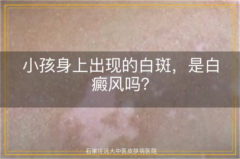 小孩身上出现的白斑，是白癜风吗？