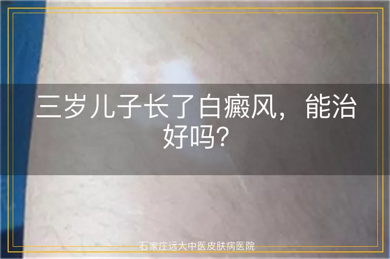 三岁儿子长了白癜风，能治好吗？