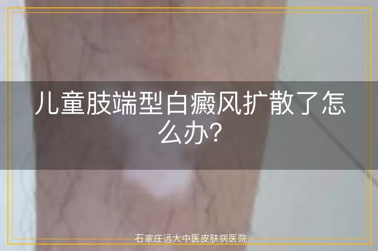 儿童肢端型白癜风扩散了怎么办?