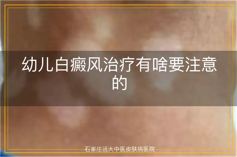 幼儿白癜风治疗有啥要注意的