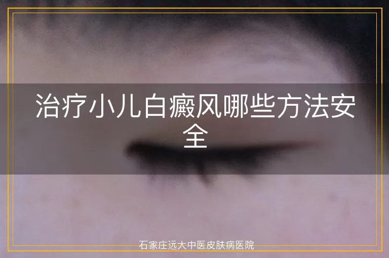 治疗小儿白癜风哪些方法安全