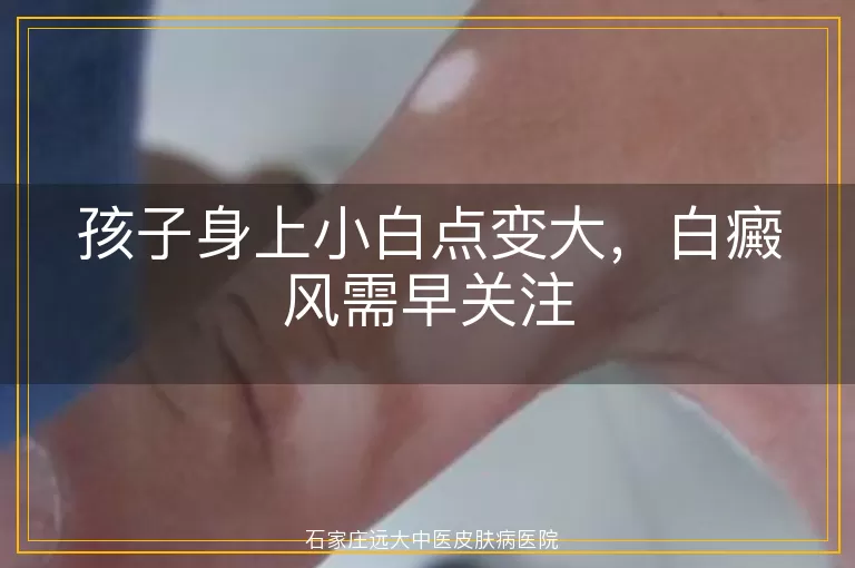 孩子身上小白点变大，白癜风需早关注