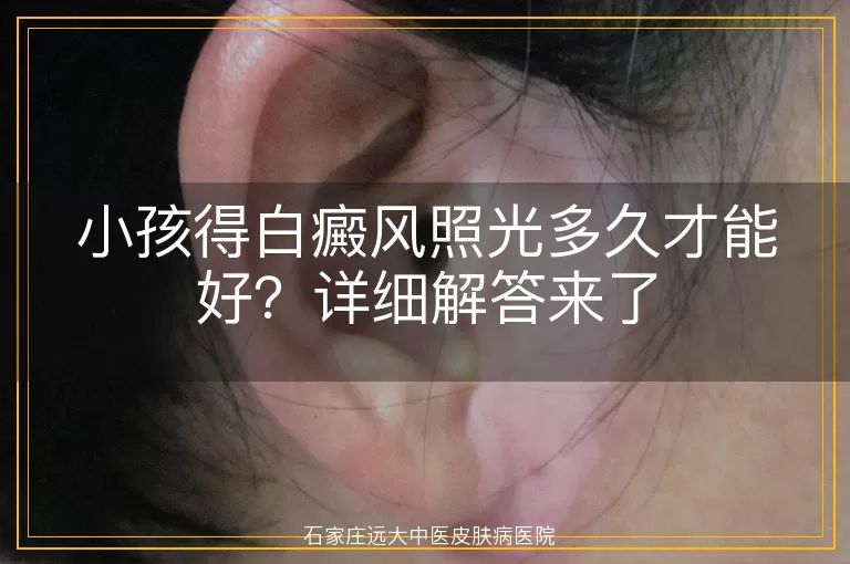 小孩得白癜风照光多久才能好？详细解答来了