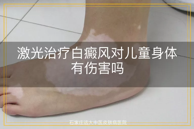 激光治疗白癜风对儿童身体有伤害吗