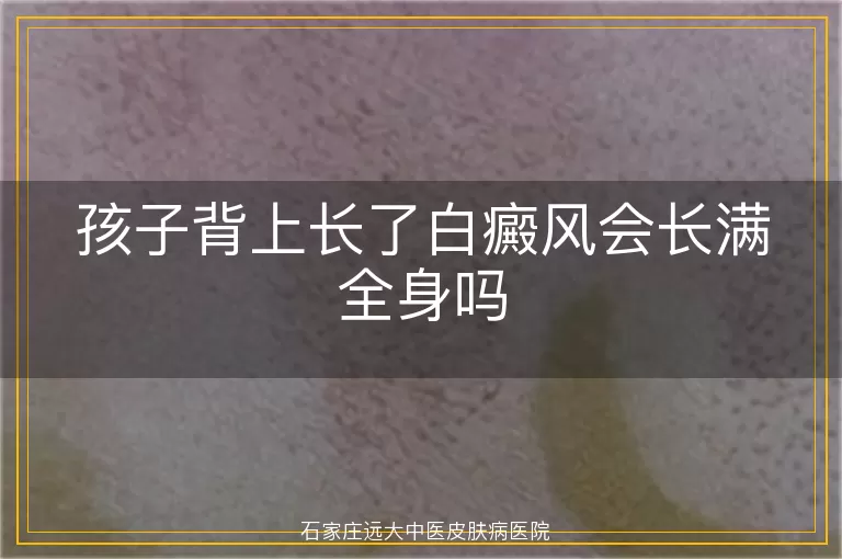 孩子背上长了白癜风会长满全身吗