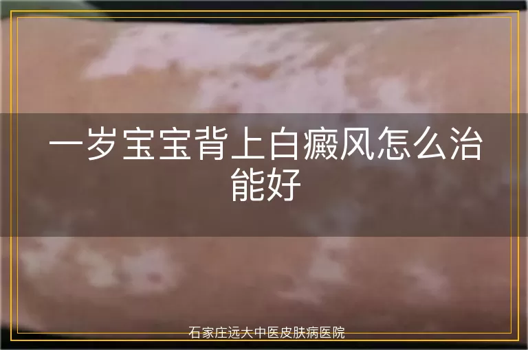 一岁宝宝背上白癜风怎么治能好