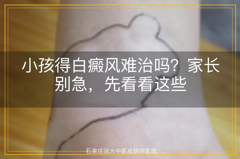 小孩得白癜风难治吗？家长别急，先看看这些