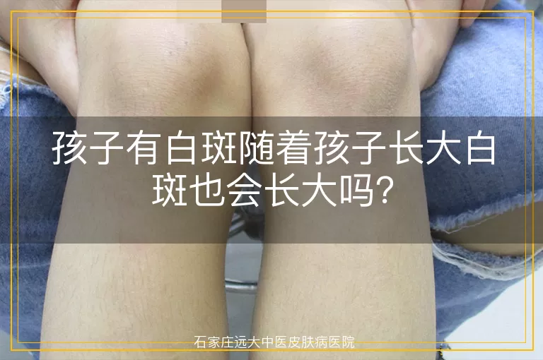 孩子有白斑随着孩子长大白斑也会长大吗？