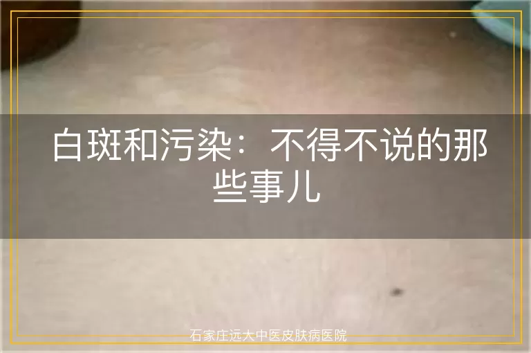 白斑和污染：不得不说的那些事儿